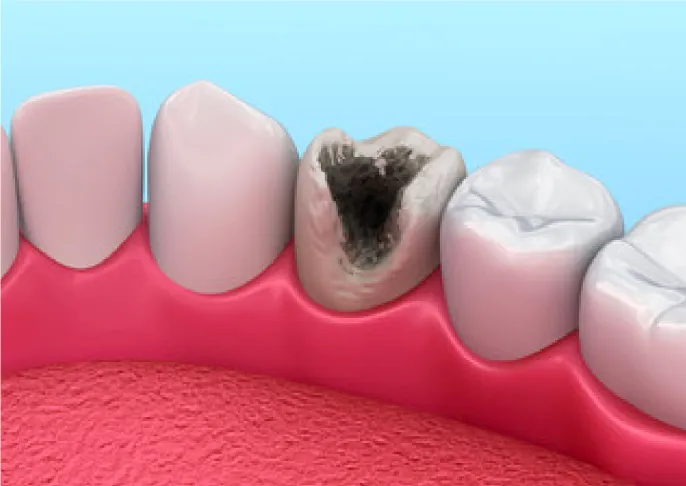 メリット1. 虫歯の再発リスクが低い