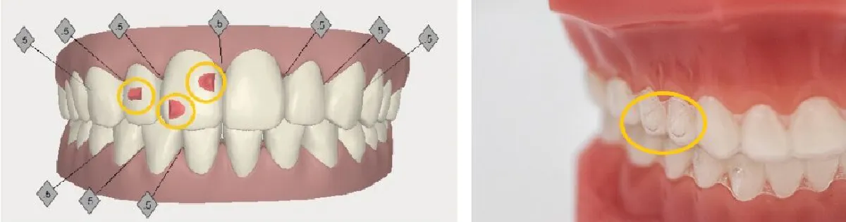 メリット4. 3次元的に歯を移動できる